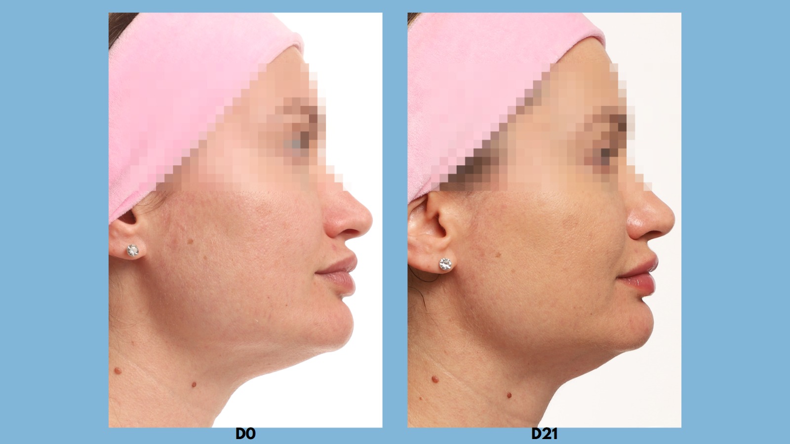 Antes e depois D0 vs D21 perfil