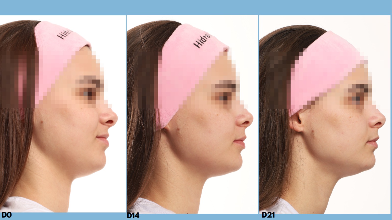 Antes e depois D0 vs D21 perfil 2