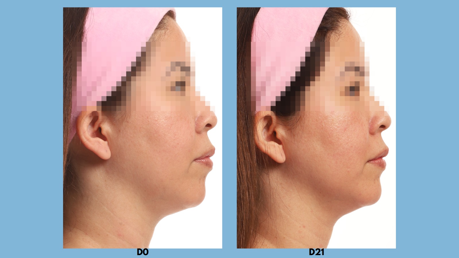 Antes e depois D0 vs D21 perfil 3